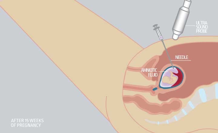 Amniocentesis 