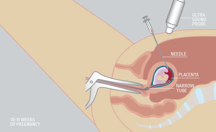 Chorionic villus sampling CVS