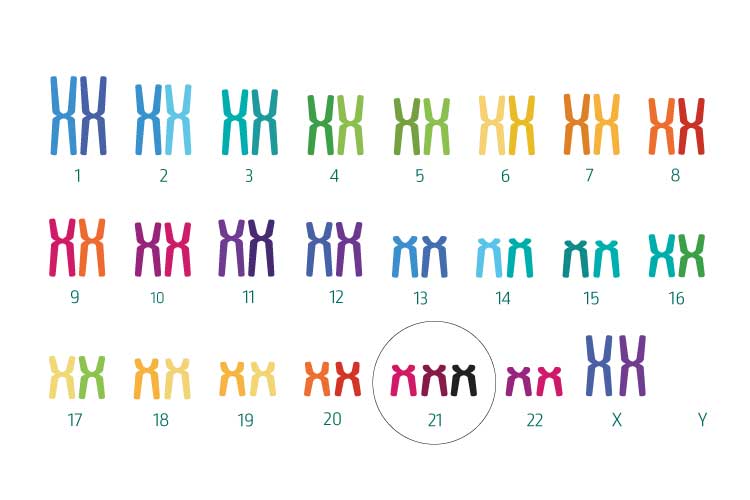 Trisomy 21 (Down syndrome)