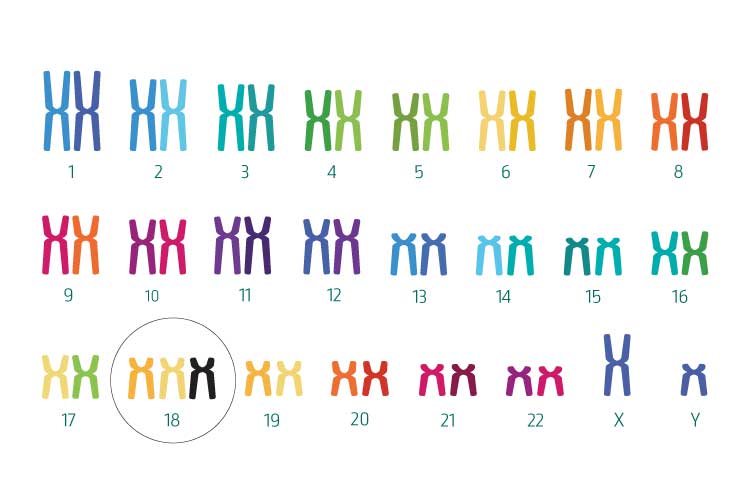 Trisomy 18 (Edwards syndrome)