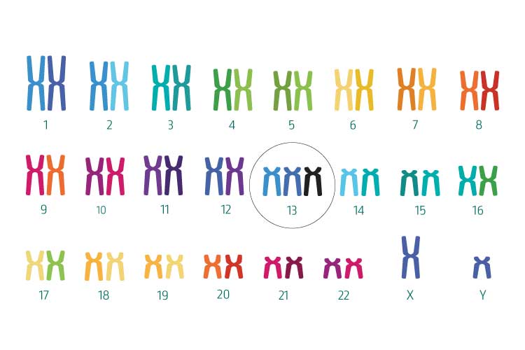 Trisomy 13 (Patau syndrome)